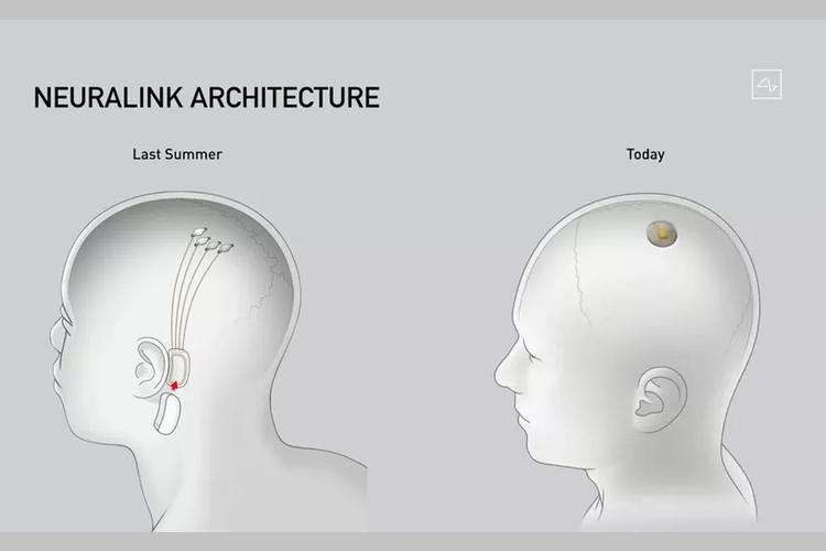 Perbedaan chip BMI Neuralink tahun lalu yang dipasang di dekat telinga (kiri) dan perangkat terbaru yang disejajarkan dengan tengkorak (kanan).(Neuralink via The Verge)
